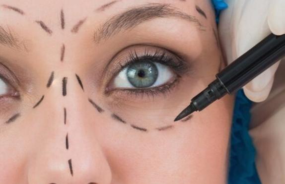 Blefaroplastia - Párpados